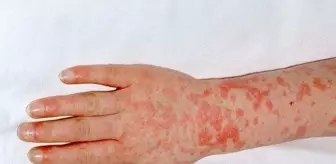 Yunanistan'da Strep-A bakterisi nedeniyle okullar kapatıldı