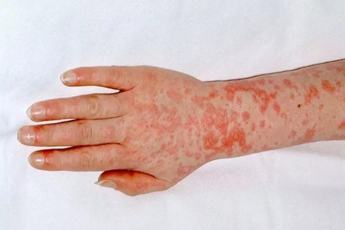 Yunanistan'da Strep-A bakterisi nedeniyle okullar kapatıldı