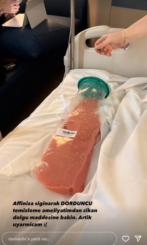 It turned into an aesthetic nightmare! The filler material removed from Danla Biliç's hip shocked everyone