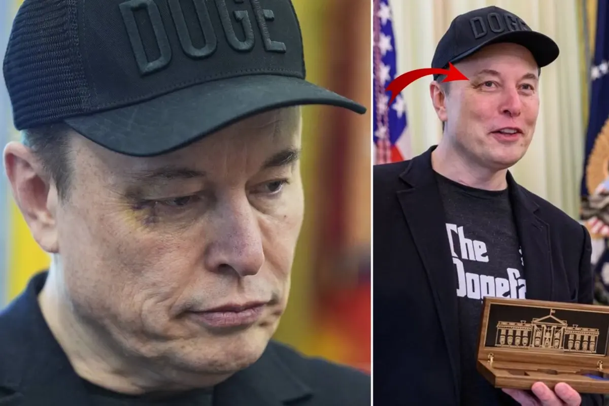 Elon Musk'ın gözündeki morlukla ilgili bomba iddia