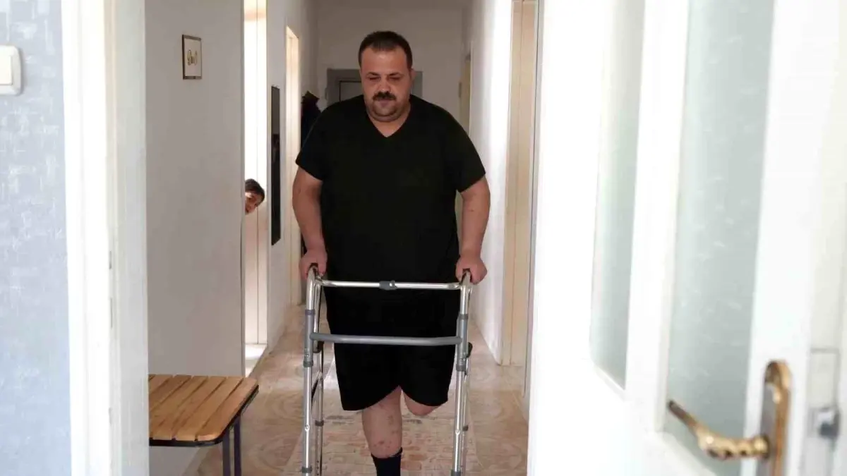 Gaziantepli Baba, Hatalı Tedavi Sonucu Ayağını Kaybetti
