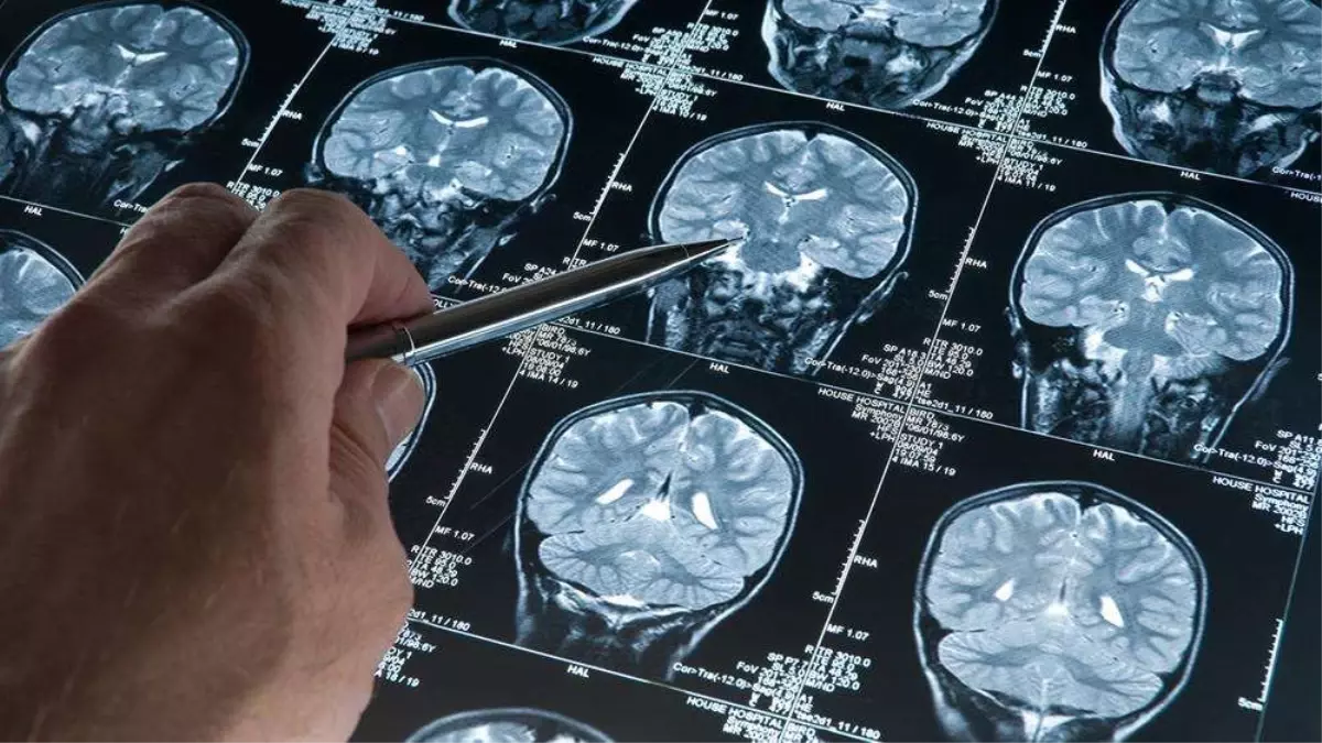 Alzheimer'ı Erken Tespit Eden Kan Testi Yüzde 95 Hassasiyetle Geliştirildi