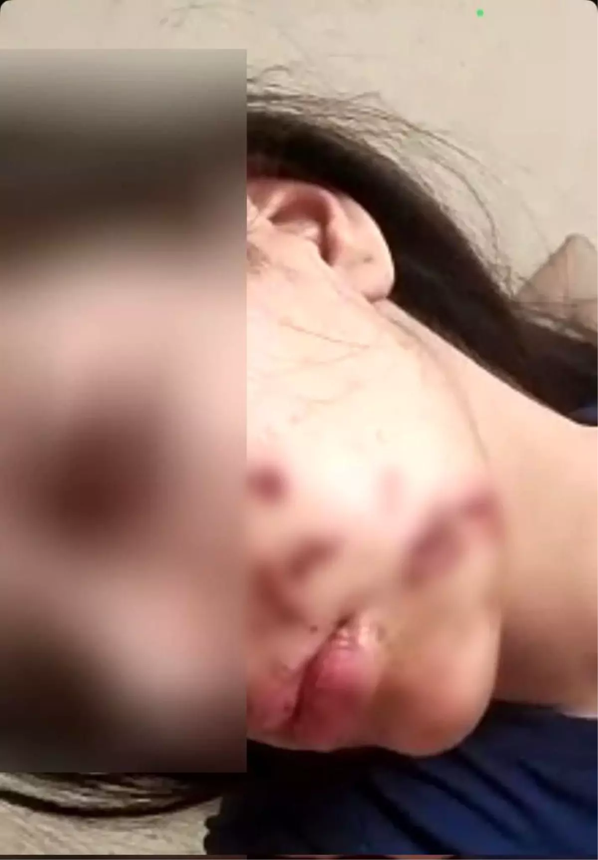 Siirt'te Torpil Patladı, Bir Genç Kız Yaralandı