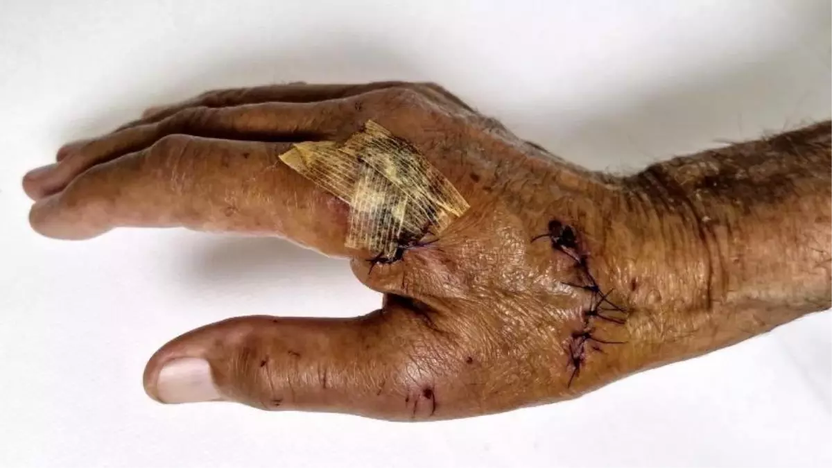 Antalya'da Duşa Kabin Camı Patladı: Emekli Öğretim Görevlisi Yaralandı