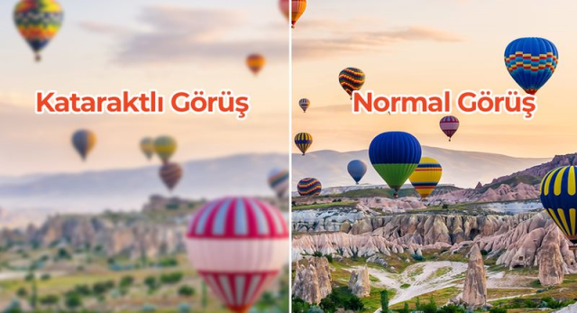 Katarakt Beklemiyor: Erteleme Görüş Kaybına Yol Açabilir