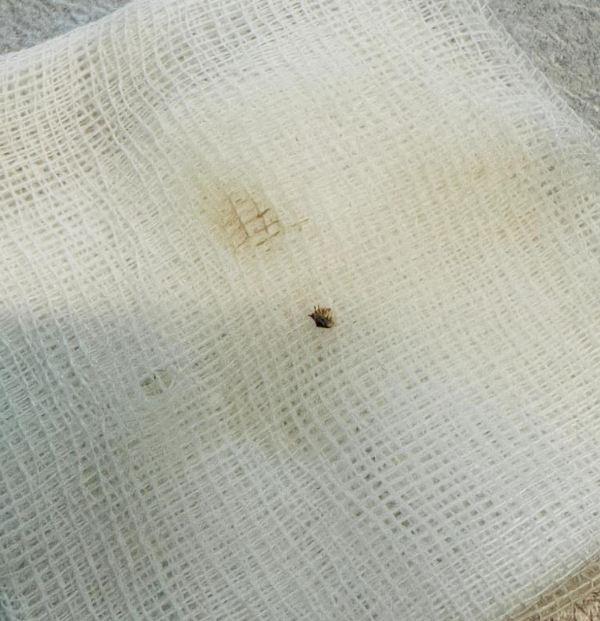 The woman who went to the hospital with complaints of weakness experienced the shock of her life! She couldn't believe what came out of her abdomen