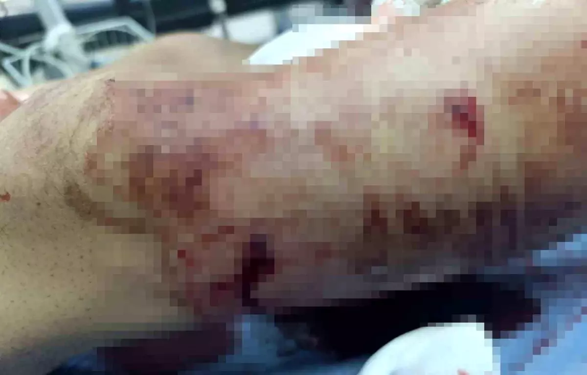 Yaylada Ayı Saldırısına Uğrayan 17 Yaşındaki Çocuk Hastaneye Kaldırıldı