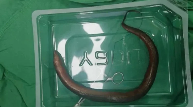 A live eel emerged from the abdomen of a man who went to the hospital with abdominal pain