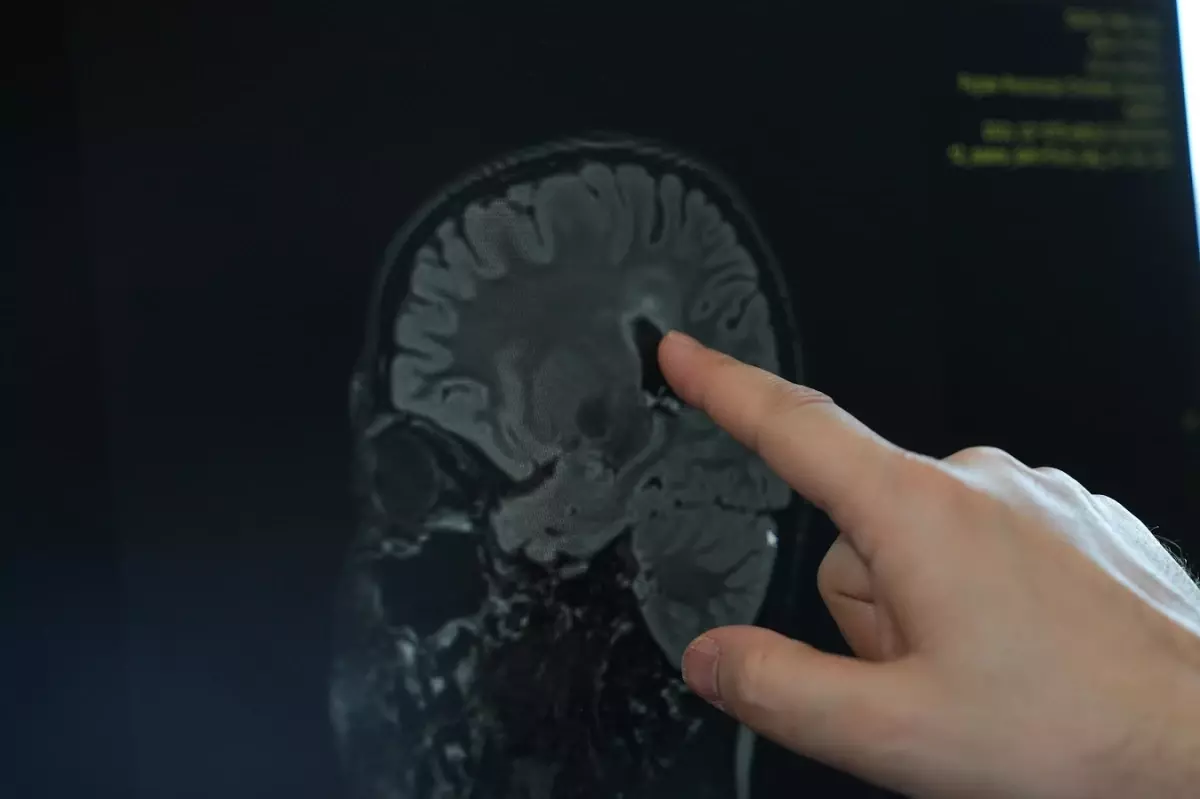 Serebral Palsi: Belirtileri ve Cerrahi Tedavi Yöntemleri