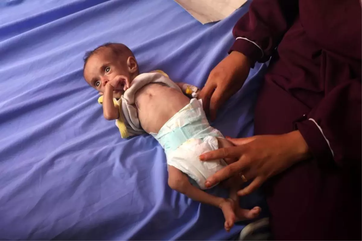 Gazze'de Açlık ve Yetersiz Beslenmeden 15 Kişi Hayatını Kaybetti