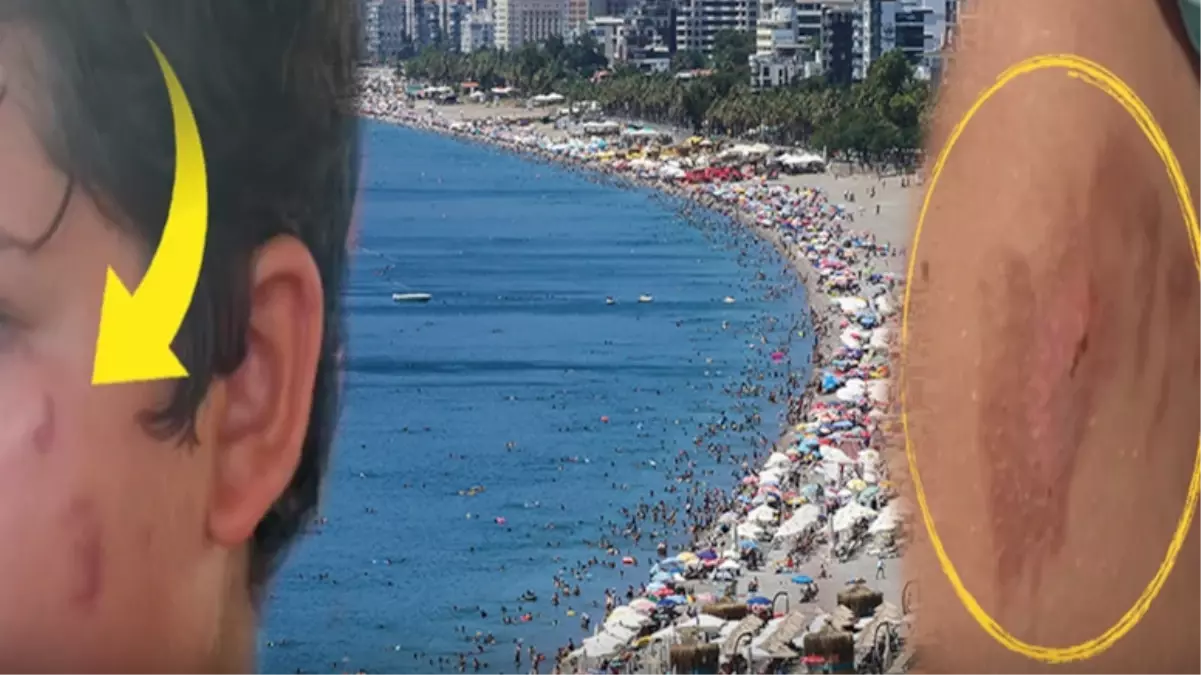 Kopalcem na turških plažah grozijo opekline