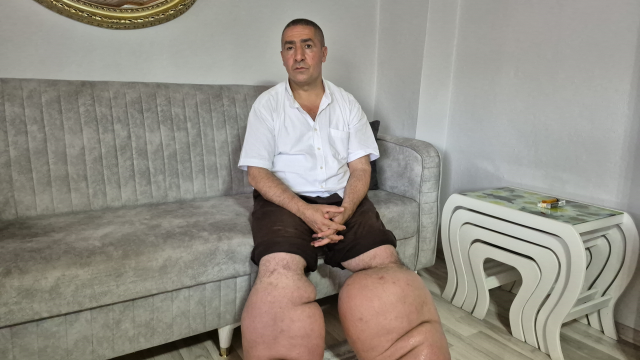 Fil Hastalığıyla Mücadele Eden Seyfettin Taşcı'nın Yardım Çağrısı