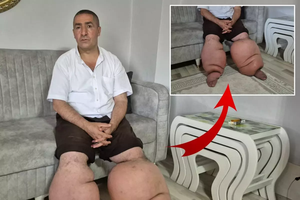 Yüksek ateş şikayetiyle hastaneye gitti, 15 yıldır 'fil hastalığı' ile mücadele ediyor