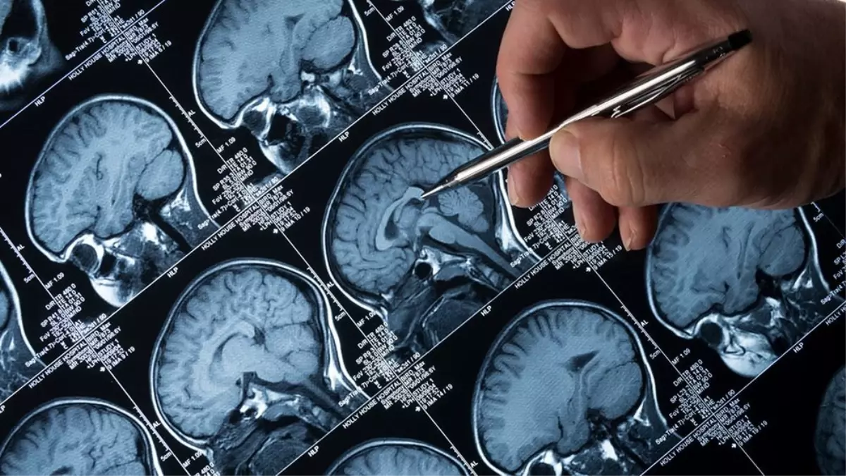 Lityum, Alzheimer'ın İlerlemesini Etkiliyor