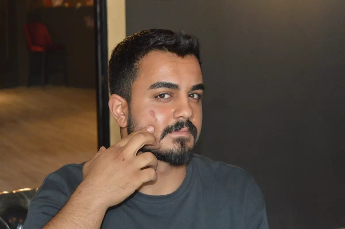Güzellik Merkezinde Lazer Epilasyon Sonrası Yanık İddiası