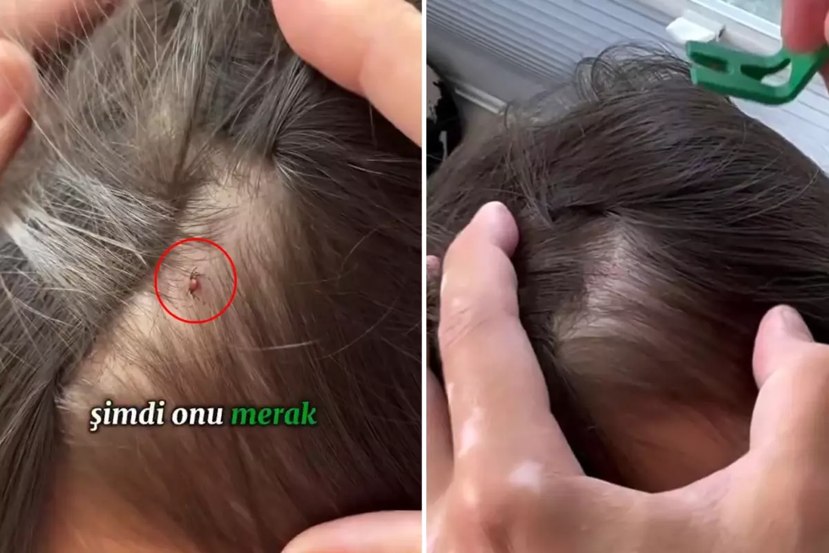 Baba, kızının kafasına yapışan keneyi böyle kopardı