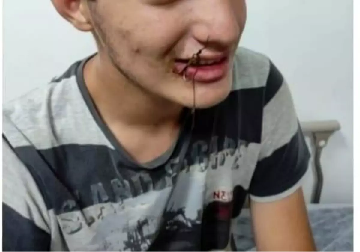 Balık Oltası İğnesi Ağızda Kaldı, İtfaiye Ekipleri Kurtardı