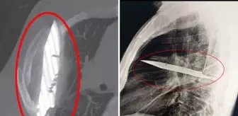 Göğüs ağrısıyla hastaneye gitti, göğsünde 8 yıldır bıçakla yaşadığı ortaya çıktı!
