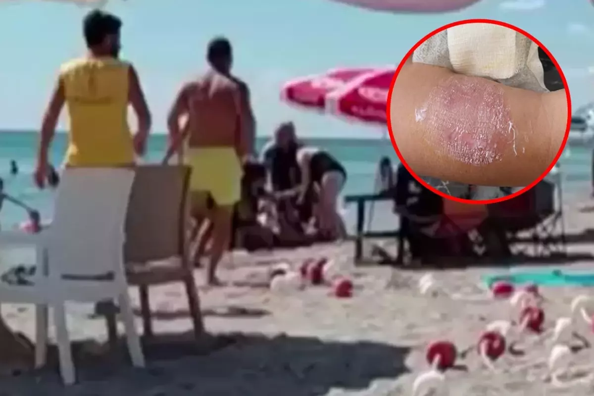 Plaj keyfi 'sigara dumanı' ile kabusa döndü, üst üste dövüşüp kolunu ısırdı