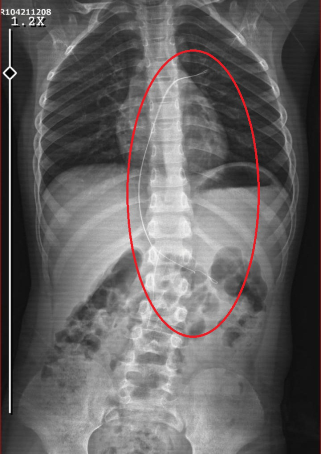 It was revealed that a catheter was left in the body of the child who started coughing after swallowing a cucumber.