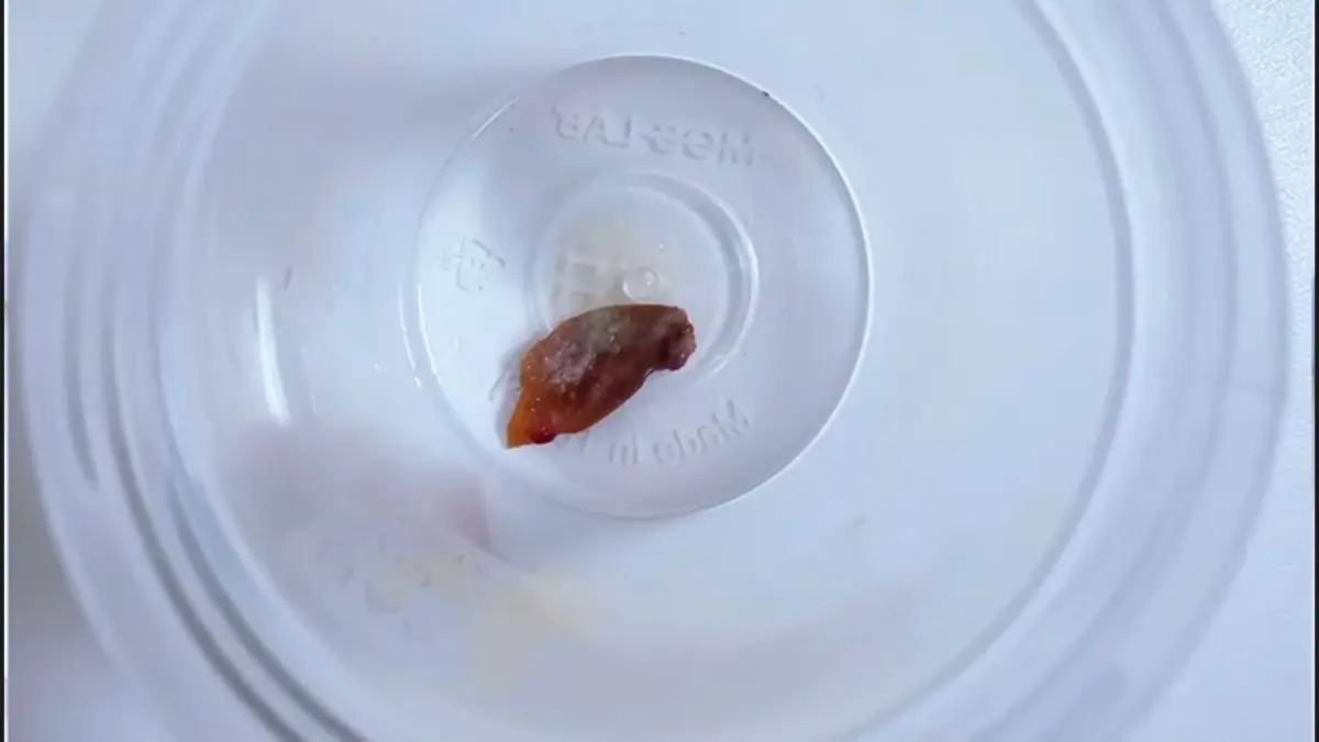 Kabak Çekirdeği 1,5 Yıldır Süren Öksürüğü Neden Oldu