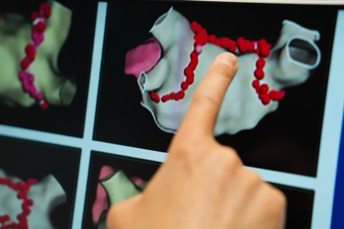 Kalp Ritim Bozukluklarında Ablasyon Tedavisi ile Yüksek Başarı Oranı