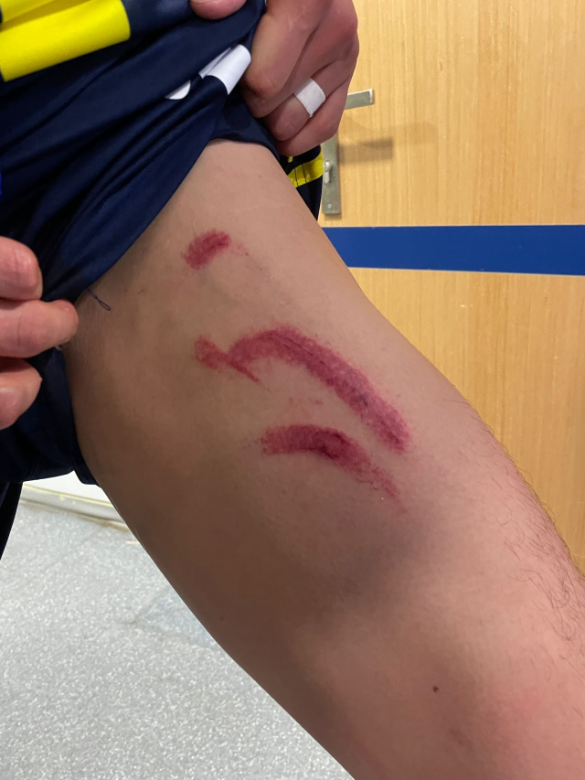 Stuttgart maçında tekme yiyen Fenerli yıldızın son hali inanılmaz