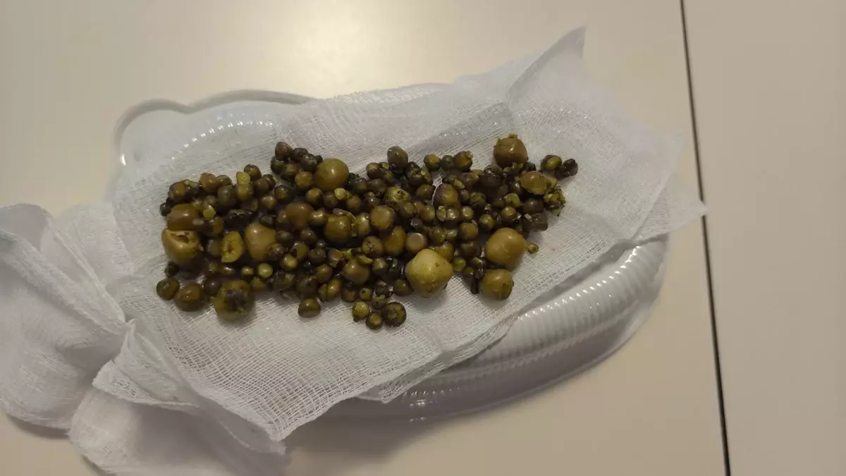 İnegöl'de 213 Safra Taşı Bulunan Kadın Başarıyla Ameliyat Edildi