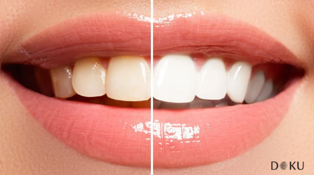 Sağlıklı ve Etkileyici Bir Gülüş İçin Uzman Dokunuşu : Diş Beyazlatma ve Diş Kaplama