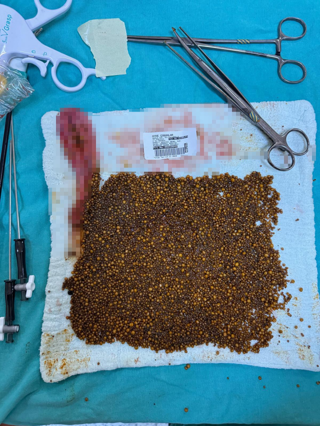 She went with abdominal pain, over 20,000 stones were removed from her gallbladder