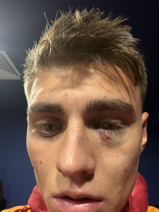 Galatasaray shared! Here is the latest state of Kazımcan Karataş's eye