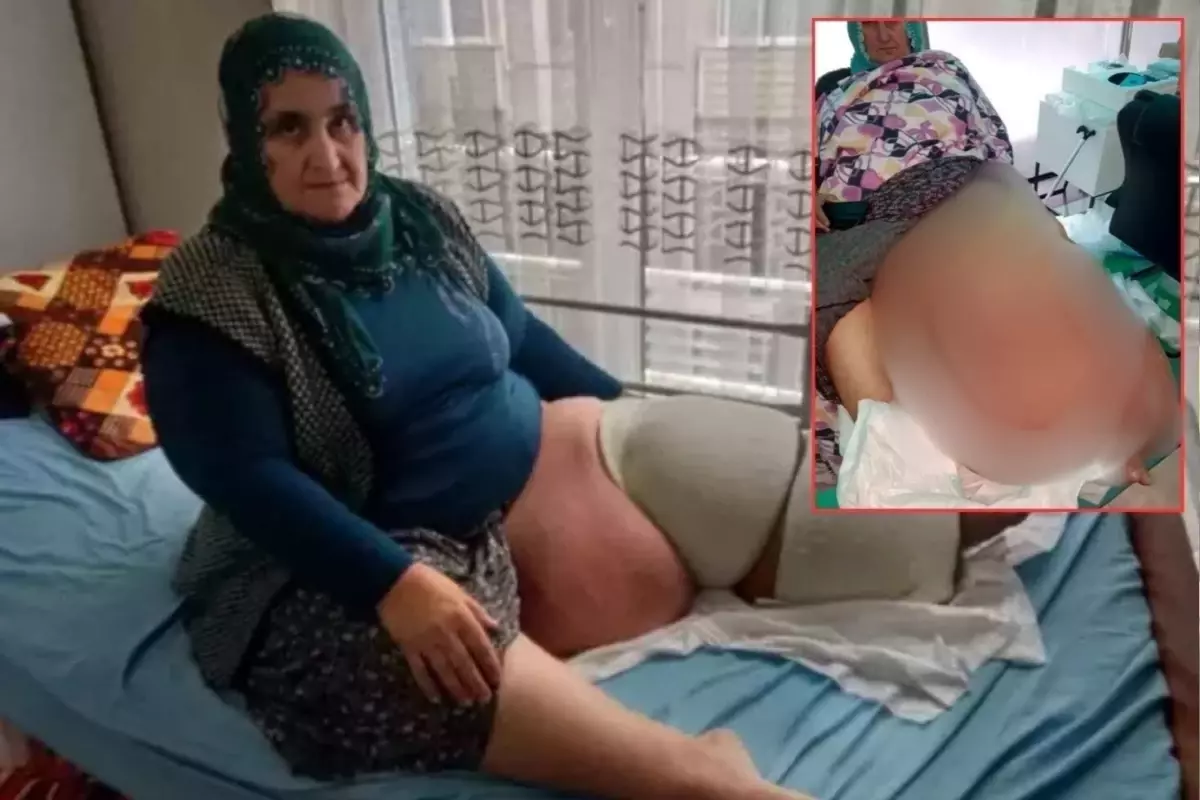 35 yıldır aynı hastalıkla mücadele ediyor! Bacağının ağırlığı 100 kiloya kadar çıktı