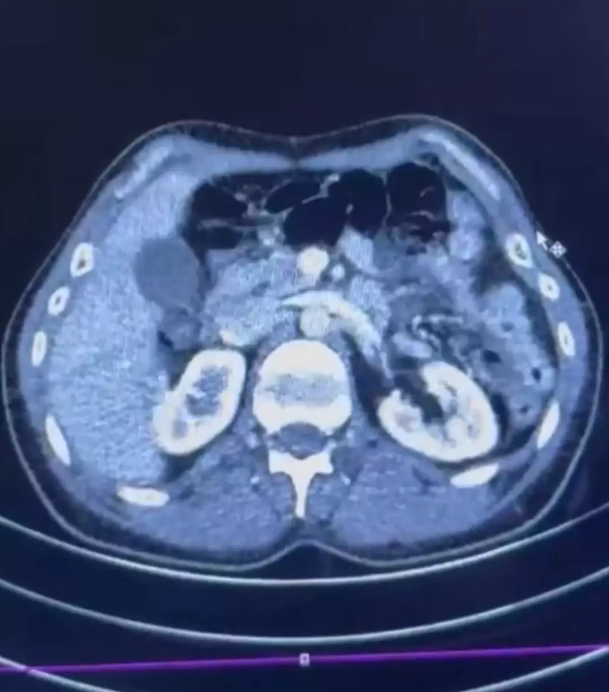 İranlı şüphelilerin midelerinde uyuşturucu tespit edildi; 3 gözaltı