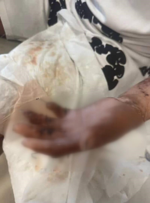 65 ameliyat geçirdi, 12 gün uyutuldu! Hayatı saniyeler içinde kabusa döndü 9 65 ameliyat gecirdi 12 gun uyutuldu hayati 19357379 2784 m