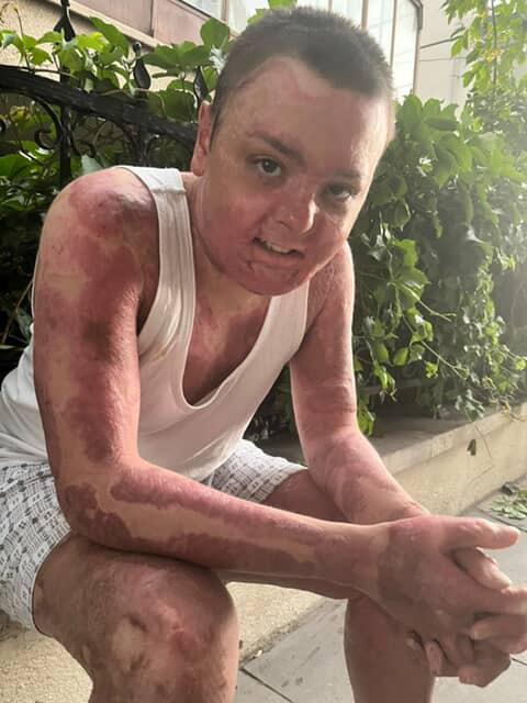 65 ameliyat geçirdi, 12 gün uyutuldu! Hayatı saniyeler içinde kabusa döndü 5 65 ameliyat gecirdi 12 gun uyutuldu hayati 19357379 3922 m