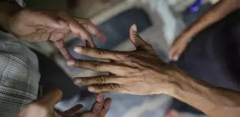 44 yıl sonra bir ilk! 2 ülkede cüzzam vakaları görülmeye başladı