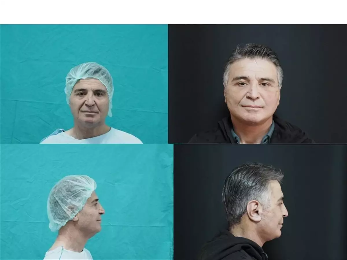 Bitlis'te ilk kez 'derin plan yüz germe ameliyatı' yapıldı