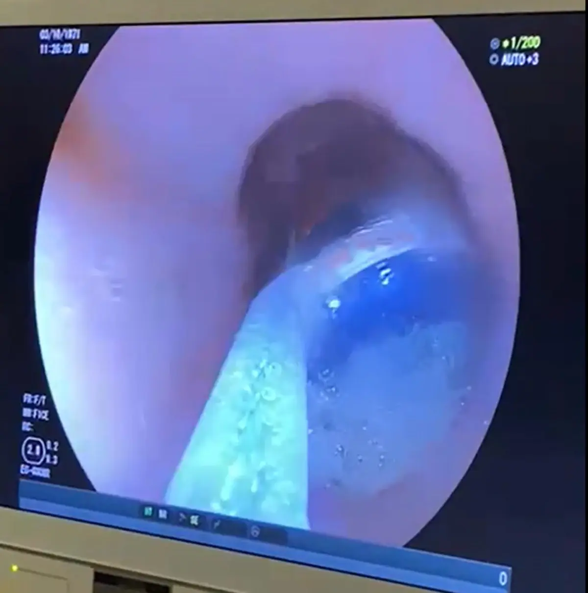 Midesindeki 9 pil, endoskopik yöntemle çıkarıldı