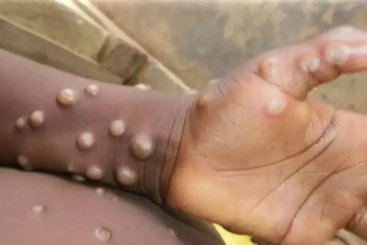 Madagaskar'da ilk defa M çiçeği vakası tespit edildi