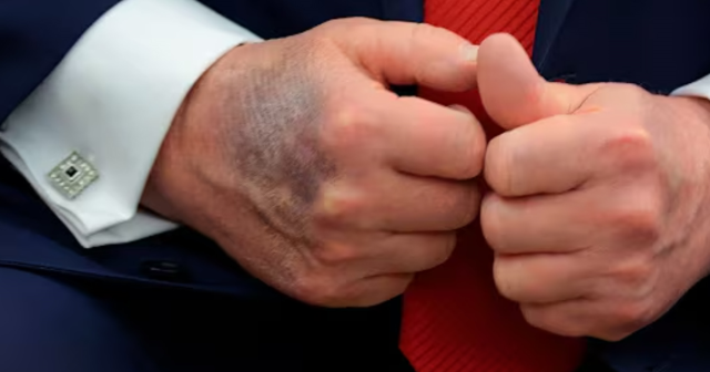 Trump explained the reason for the bruises on his hands for the first time