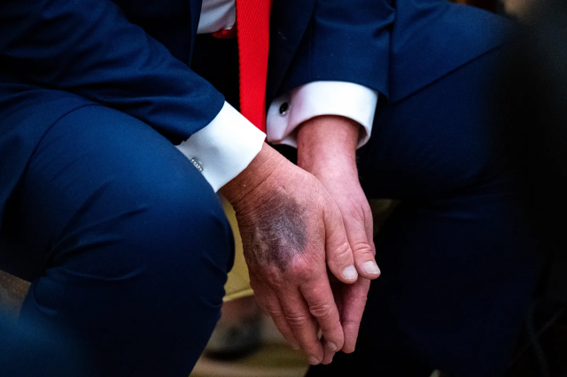 Trump explained the reason for the bruises on his hands for the first time