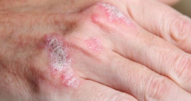 Egzama bulaşıcı mı? Egzama nedir, bulaşıcı mı, nasıl tedavi edilir?