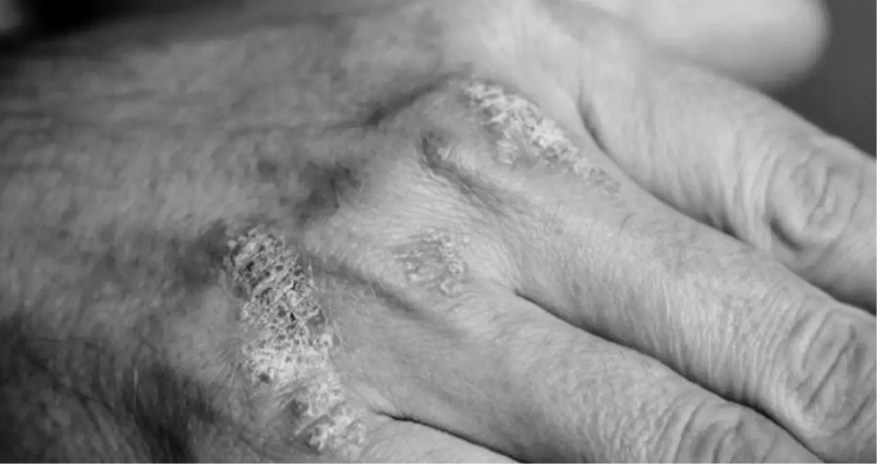 Egzama bulaşıcı mı? Egzama nedir, bulaşıcı mı, nasıl tedavi edilir?