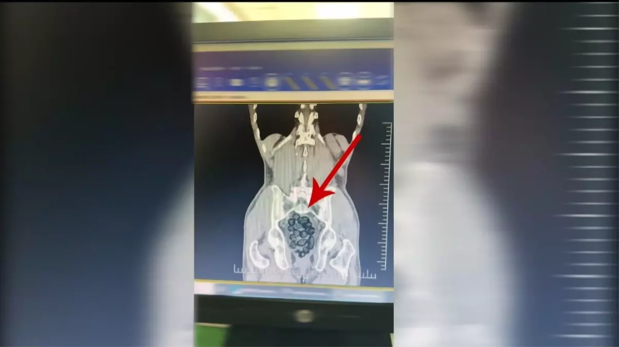 Yolcunun midesinden 472 gram metamfetamin çıktı