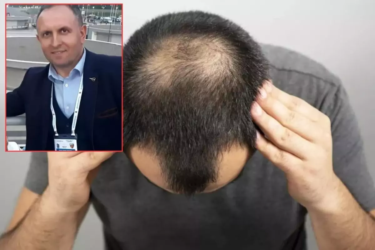 Saç ekimi sırasında fenalaştı, hayatını kaybetti