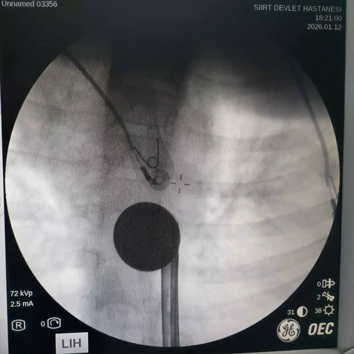 Siirt'te çocuğun boğazına kaçan madeni para müdahaleyle çıkarıldı