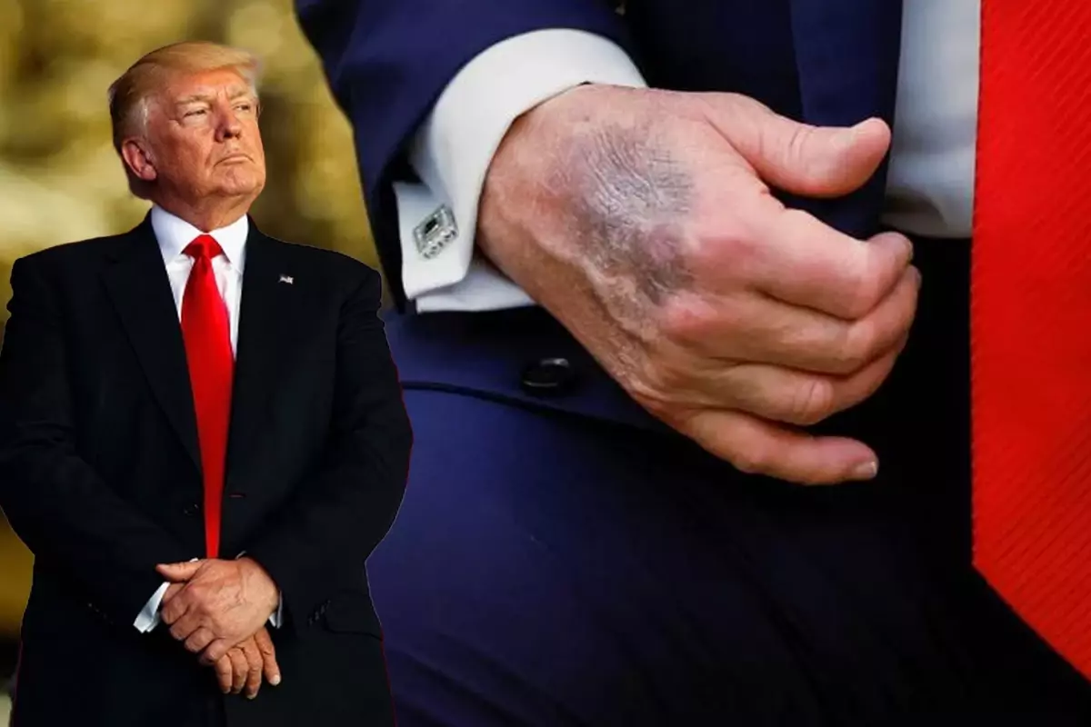 Trump elindeki morluğun nedenini açıkladı