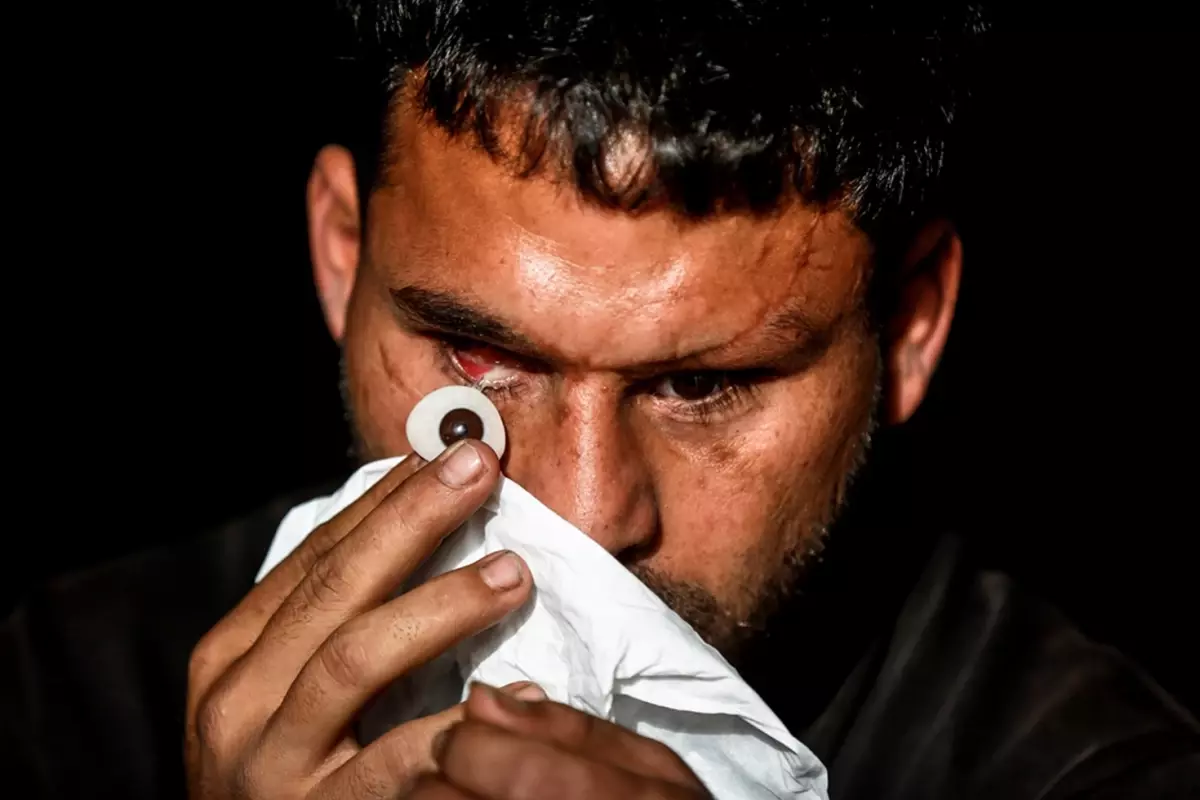 Savaşta iki kez yaralandı, gözlerini kaybetti