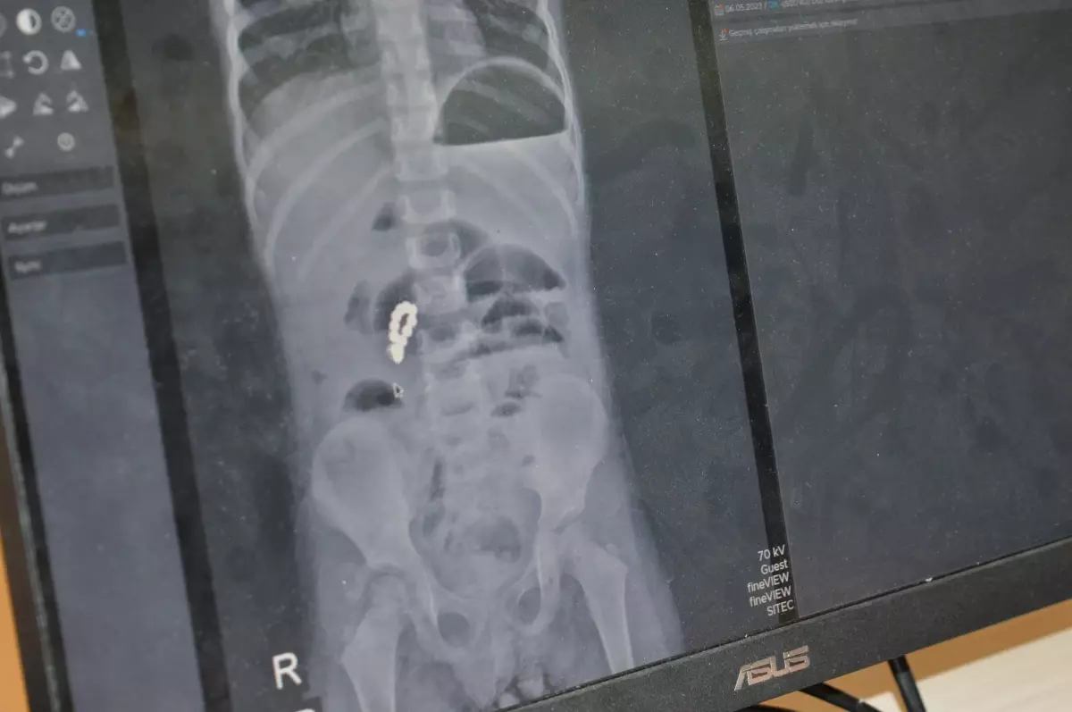 Mıknatıslı boncuklar bağırsaklarını delip tıkadı, 4 yaşındaki kız 8 adet mıknatıs çıkarıldı