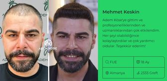 En İyi Saç Ekimi Merkezi Nasıl Seçilir? Adem Köse ile Doğal Sonuçların Peşinde